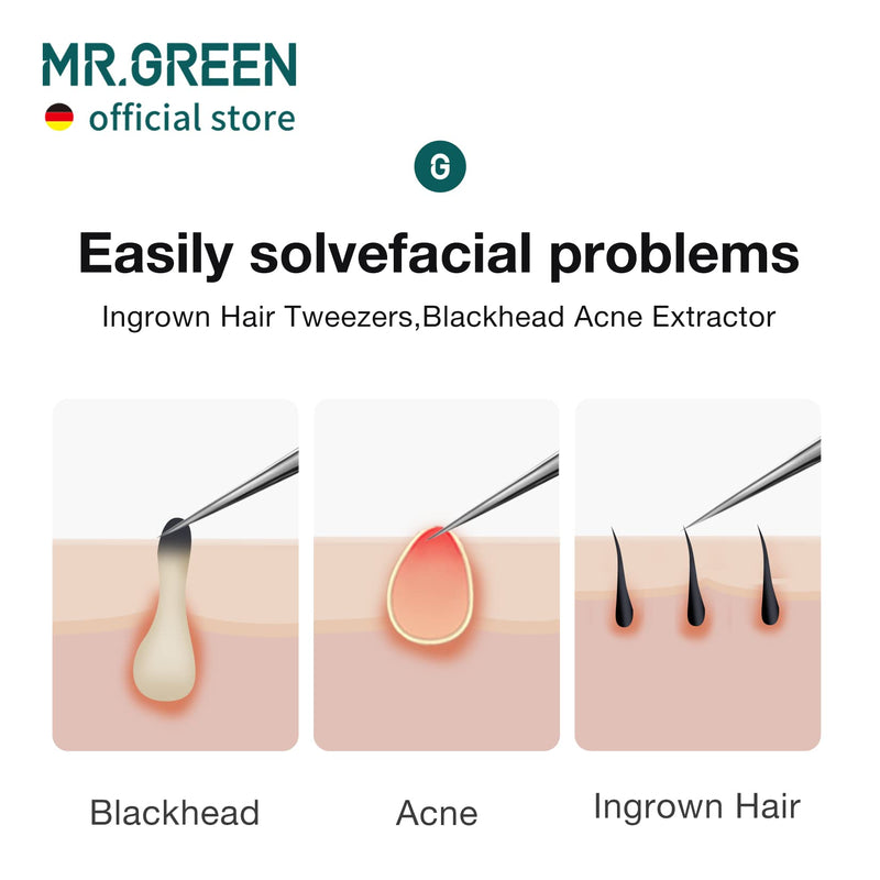 MR.GREEN Ingrown Hair Tweezers Needle Nose Pointed Tips Tweezers For Eyebrows Splinters Blackhead Removal Acne Clip Extractor (Short) Short