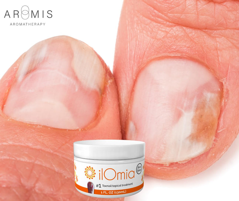 Natural Toenail Fungi Cream - For Damaged, Cracked,Yellowed and Discolored Nails - 1oz bottle - Made in the USA (1) 1.0 Ounces