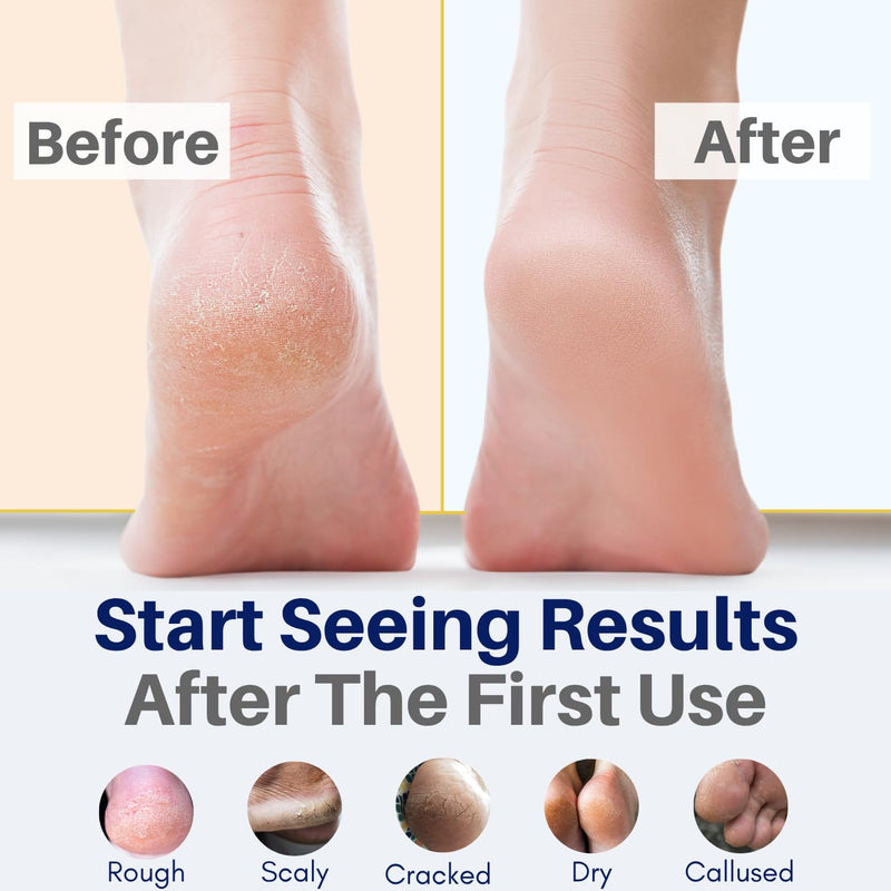 All Natural Foot Cream for Cracked Heels & Dry Feet – USA Made Organic Foot Balm for Callus Softening – Hydrating Foot Care Moisturizer with Peppermint, Tea Tree, Lavender & Eucalyptus 4 Fl Oz (Pack of 1)