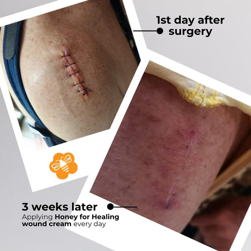 [Australia] - Manuka Honey Wound Cream with UMF 15+, Fast-Absorbing, Non-Sticky Formula for Cuts, Burns, Scrapes, Minor Injuries ‚Äì 1.75oz / 50 g 