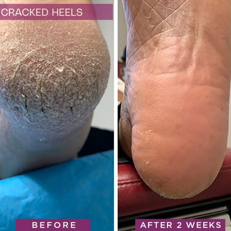 Rapid Crack Repair Cream, 25% Urea with Lactic Acid, Restores Cracked Heels and Diabetic Feet, Post-Surgery Scar Care, Fragrance-Free Barrier Cream, 3 oz 1