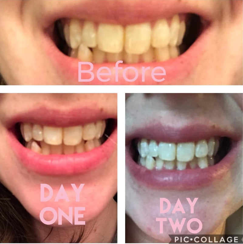 [Australia] - Teeth Whitening Kit with LED Light, 3 Carbamide Peroxide Teeth Whitening Gel Express Teeth Whitener. Remove Stains from Coffee, Smoking, Wine, Food (5 Piece Set) 3 Count (Pack of 1) 
