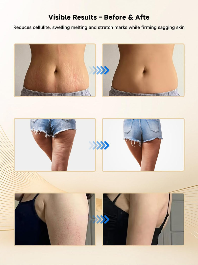 [Australia] - Lymphatic Drainage Massager, Electric Anti Cellulite Massage Tool, Helps Reduce Stretch Marks & Cellulite for Legs & Arms & Belly, Body Sculpting Machine with Microcurrent, Light, Heat & Vibration 