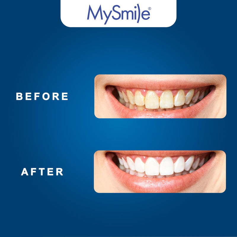[Australia] - MySmile Teeth Whitening LED Light with Teeth Whitening Trays, Tooth Whitening Accelerator Light for Whitening Teeth, Mouth Tray Teeth Whitener Enhancer Light Trays - Only 1Pcs Light Blue 