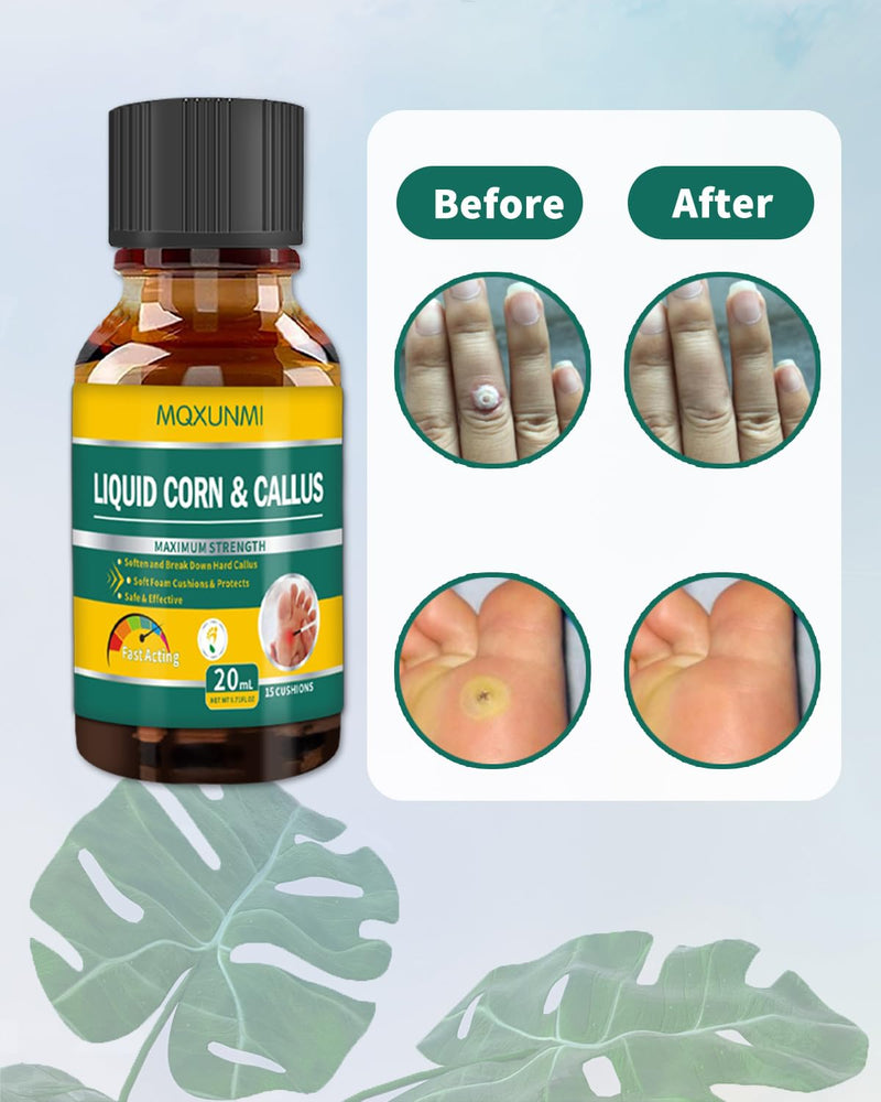 [Australia] - MQXUNMI 20 ml corn remover, corn remover, against corns and callus remover, corn remover, corn relief from corn pain and foot care 