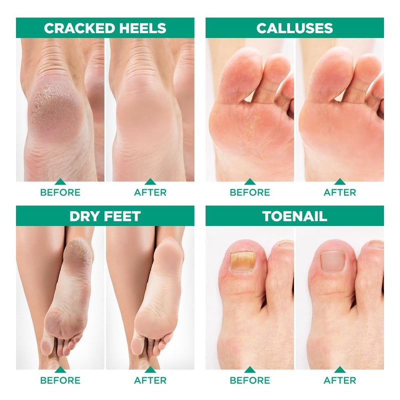 [Australia] - Tea Tree Oil Foot Soak and 40% Urea Cream - for Dry Cracked Feet with Maximum Strength 