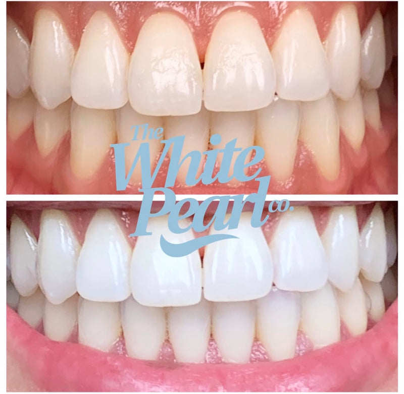 [Australia] - Teeth Whitening Kit with LED Light, Wireless, 35% Carbamide Peroxide, Desensitizing Agent, Enamel Safe, Gentle on Teeth 