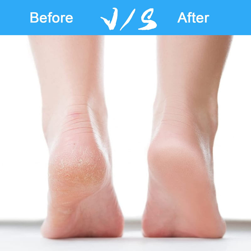 [Australia] - Czemo Electric Callus Remover Rechargeable Callus Planer with 3 Replacement Rollers Waterproof Callus Rasp Foot Care for Feet, 2 Speeds 