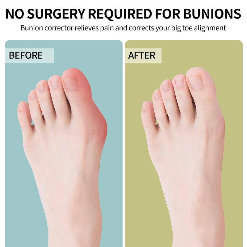 [Australia] - Bunion Corrector for Women & Men ：2-in-1 Adjustable Big Toe Relief Bunion Splints Hammer Toe Straightener，Comfortable, Effective Double Correction，1 set 1 set 
