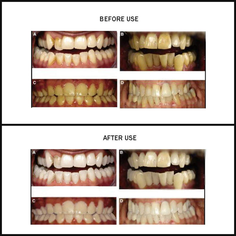 [Australia] - Teeth Whitening Light, 32 LED Red & Blue Light Intelligent Teeth Whitening System, LED Blue Lights Accelerator with USB for Stain Removal at Home (Black)…… Black 