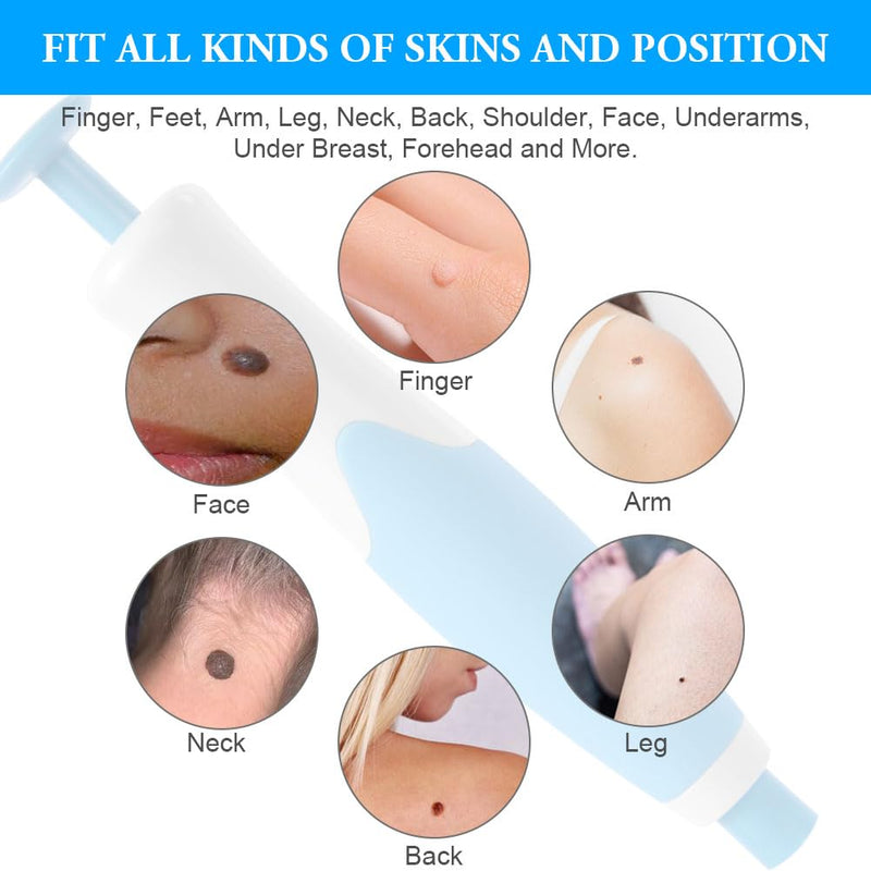 [Australia] - ACWOO Stem Wart Removal Quick Kit, Stem Wart Remover, Skin Tag Remover Kit for Micro to Large 2MM-8MM, Wart Remover Safe and Painless, for Most Body Parts Blue 