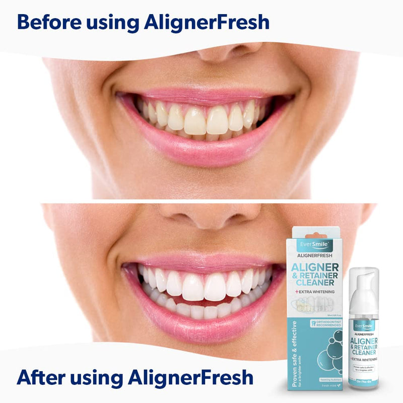 [Australia] - EverSmile AlignerFresh Extra Whitening Aligner & Retainer Cleaning Foam. AlignerFresh Cleaning Foam for Invisalign, ClearCorrect, Essix, Hawley Trays/Aligners. Cleans, Kills Bacteria & Whitens Teeth. 