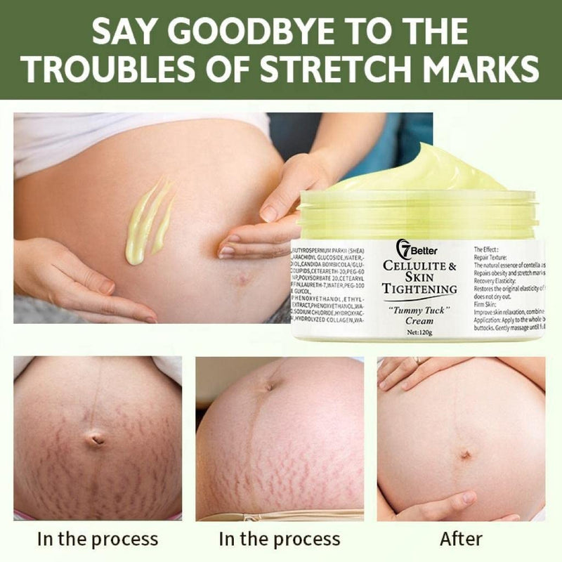 [Australia] - Stretch Marks and Scars Removal Cream for Pregnancy - Scars Repair, Abdominal Firming, and Gentle Stretch Marks Eradication Skincare Body 