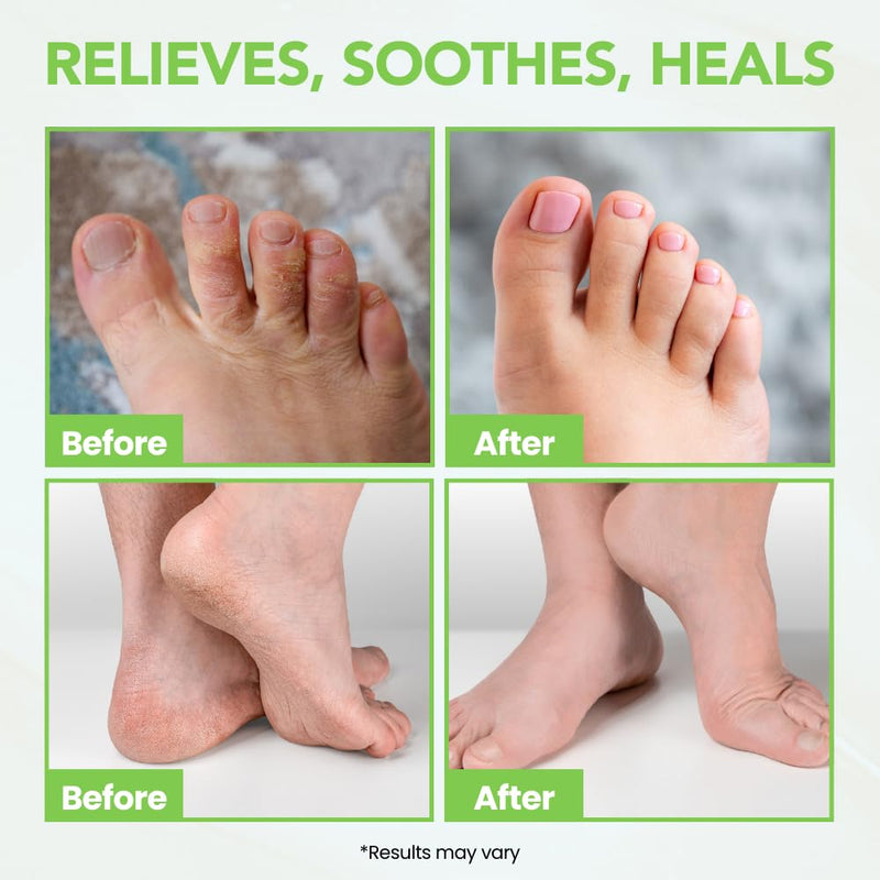 Thena Athletes Foot Cream Extra Strength Herbal Relief with Tea Tree Neem & Menthol, Athletes Foot Treatment Balm for Itchy Dry Cracked Feet, Heels and Toes, Advanced Plant-Based Foot Care Power6 Blend 2 Ounce (Pack of 1)