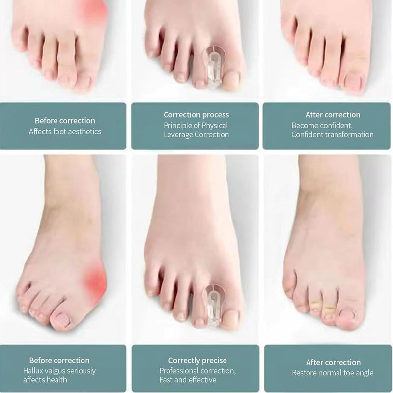 [Australia] - MEMNUN's soft and highly elastic SEBS toe separators, hallux valgus, bunion, hammer toe, overlapping toe corrector, yoga toe separators, 10 pieces 