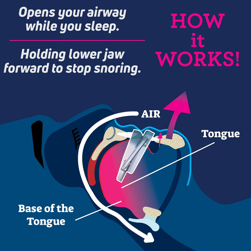 [Australia] - Anti Snore Device. New Customizable Snore Reducing Mouthpiece – Reduce Snoring Aid for Men and Women – Most Comfortable and Adjustable Oral Appliance - Holds Jaw Forward to Open Airway 