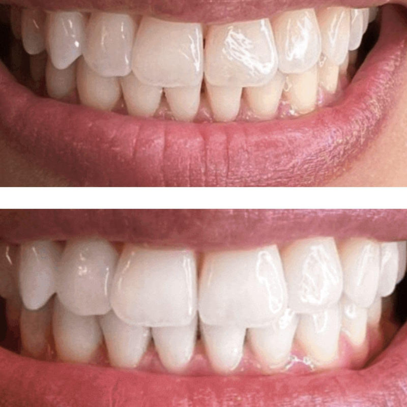 InstantGlo Teeth Whitening Kit with 32X LED Light, 35% Carbamide Peroxide Whitening Gel Pens, Fast Teeth Whitener for Sensitive Teeth, Enamel-Safe, Dentist-Trusted incl. Mouth Tray