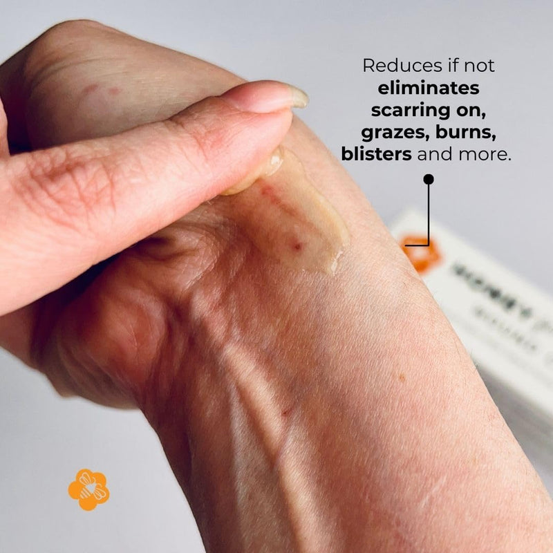 [Australia] - Manuka Honey Wound Cream with UMF 15+, Fast-Absorbing, Non-Sticky Formula for Cuts, Burns, Scrapes, Minor Injuries ‚Äì 1.75oz / 50 g 