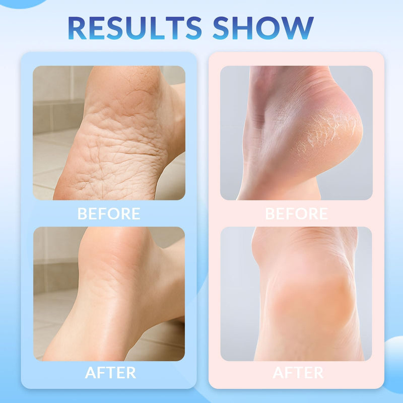 [Australia] - Crack Feet Prevention Stick, Foot Care Cream, Anti Cracked Foot Balm, Softening and Nourishing Creams for Dry, Remove Dead Skin and Moisturize Dry Skin (BLUE+PINK) BLUE+PINK 