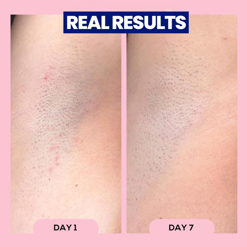 [Australia] - Megababe Après Shave | Post-Shave & Waxing | Ingrown Hair & Razor Bump Roll-On Treatment for Women | Bikini, Armpits & Legs | 3.0 fl oz 
