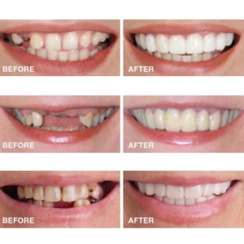 [Australia] - 2 Pairs,Regain Confidence Smile,Adjustable for Men and Women,Beautiful Smile(White) 