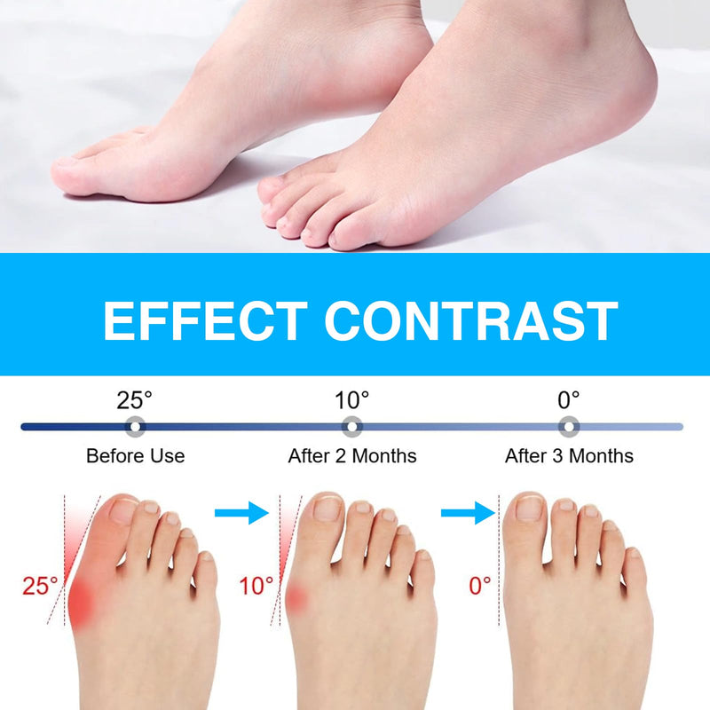 [Australia] - Katyjun 2x Hallux Valgus correction splint with 2x toe separators, bunion corrector 