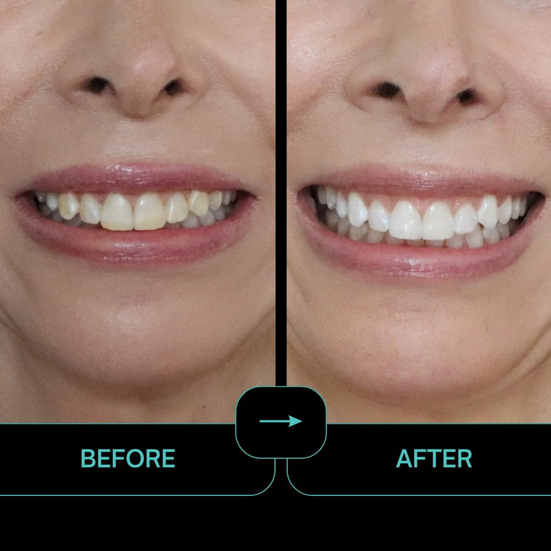 [Australia] - Prostrips - 12 Shades Whiter Teeth - 56 Enamel Safe REMINERALIZING Gentle Strips – 97% Had No Sensitivity - Bonus Size 