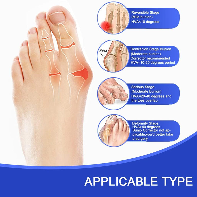 [Australia] - Hallux Valgus Toe Corrector Toe Separator Bunion Splint 【2025 Updated】Bunion Correction Set Bunion Correction Set Bunion Bandage Bunion Exercise Belt Orthopedic Set Inflamed 