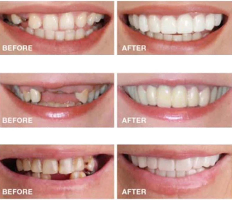 [Australia] - 2 Pairs, Temporarily Adjustable for Men and Women, Nature and Comfortable Regain Confidence Smile(White) White 