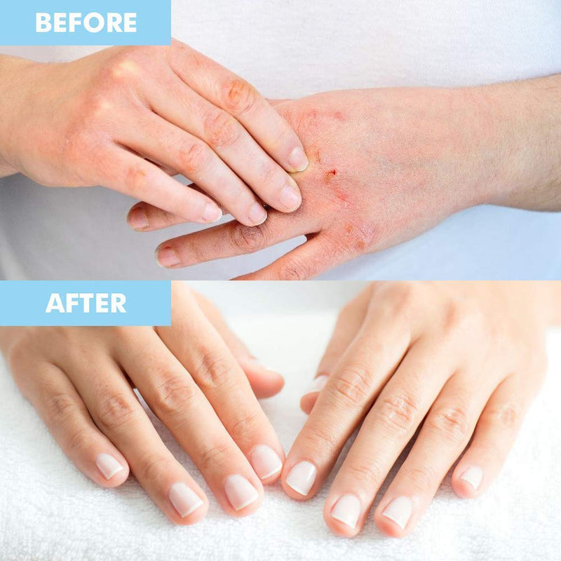 [Australia] - Bodipure Premium Hand and Foot Mask | Moisturizing Kertain Gloves & Socks | Hydrating Dull Dry Hands, Cracked Heels, Callus Softening & Nail Strengthening | Chemical-Free Feet Treatment | (6+6 Pack) 