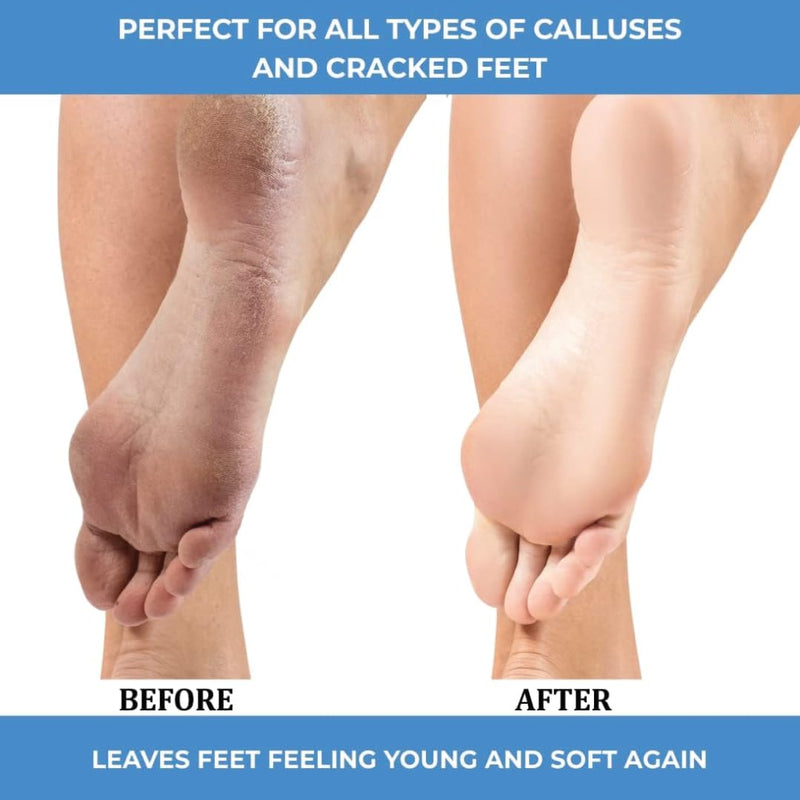[Australia] - ForPro Professional Collection Advanced Callus Eliminator Gel, Professional Grade, No Drip Callus Remover Gel for Feet, 8 oz. 1 Count (Pack of 1) 