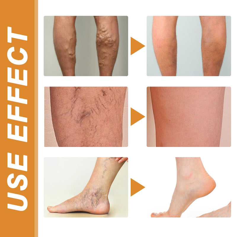 [Australia] - Grgowe varicose veins cream + vein repair spray, varicose veins cream, cream against spider veins, veins active, spider veins, relieves leg pain and swelling 