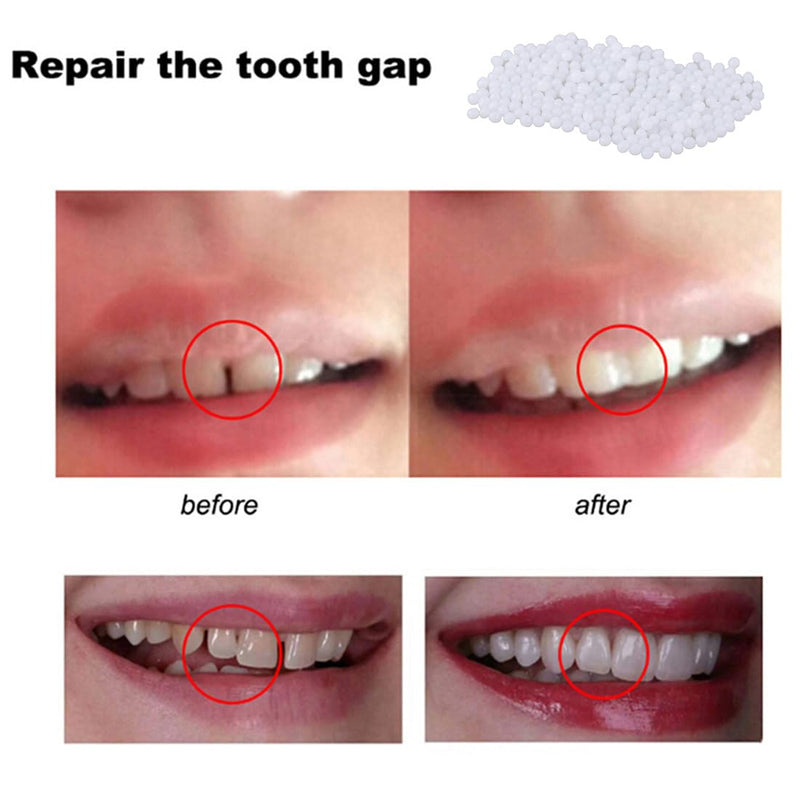 [Australia] - 100 g temporary tooth repair beads and 1 piece of fake braces, tooth repair set, adhesive tooth beads, dentures, temporary teeth, tooth filling material, thermal adhesive beads 