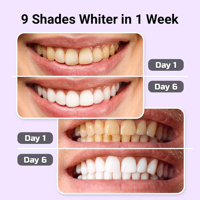 [Australia] - Teeth Whitening Kit – LED Light & Whitening Gel with Remineralization Syringes – Professional-Grade Whitening for Sensitive Teeth – Removes Stains from Coffee, Wine, & Smoking 