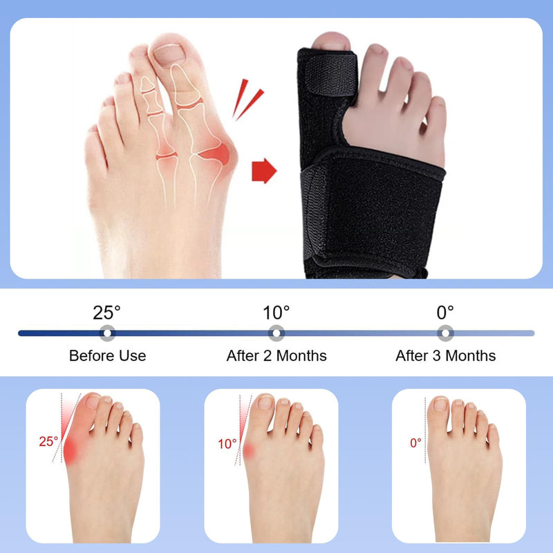 [Australia] - Landrain 1 pair of hallux valgus correction, hallux valgus splint, correction splint 
