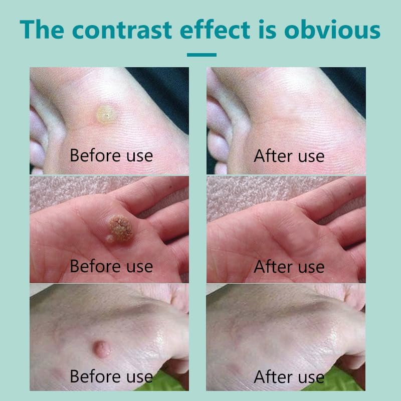 [Australia] - Maximum Treatment Liquid Corn Remover and Callus Remover for Fast-Acting Foot Care - Plantar and Common Callus Remover Treatment for Kids and Adults 