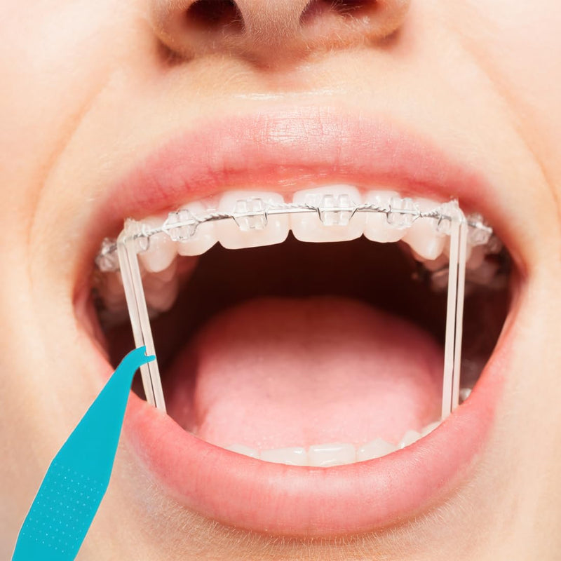[Australia] - WeddHuis 8pcs Orthodontic Elastic Disposable Plastic Braces Braces Material Placement Removal Tools Elastic Rope Hook 