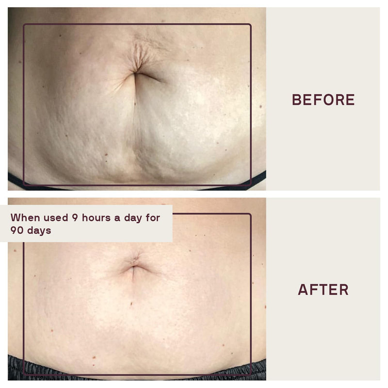[Australia] - Dermaclara Silicone Body Patch to Prevent and Treat Stretch Marks - Pregnancy Safe Skin Care Silicone Patches for Scars - Stretch Mark Prevention Pregnancy Must Haves - 5" x 5" x .07" 