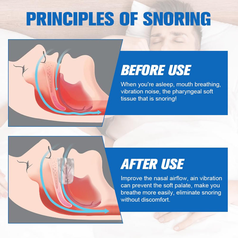 [Australia] - ACWOO anti snoring mouthpiece, snoring stopper, effective bite splints, night bite splint against teeth grinding and snoring for men women anti-snoring device 