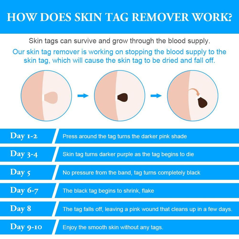 [Australia] - ACWOO Stem Wart Removal Quick Kit, Stem Wart Remover, Skin Tag Remover Kit for Micro to Large 2MM-8MM, Wart Remover Safe and Painless, for Most Body Parts Blue 