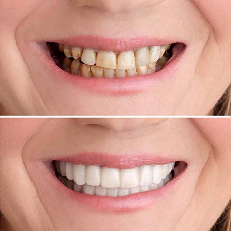 [Australia] - ‌2 Pairs Adjustable Temporary for Men & Women, Natural Comfortable Design to Restore Confident Smile (1) 1 
