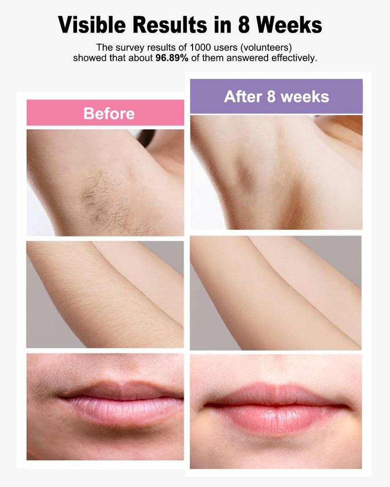 [Australia] - IPL Laser Hair Removal Device Permanent for Women & Men, 999,999 Flashes Safe Effective Lasting Hair Remover, Alternative to Salon, for Face Arms Armpit Legs Bikini Area Whole Body Home Treatment 