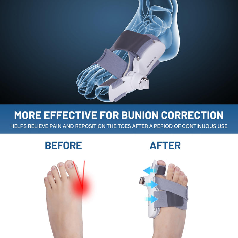 [Australia] - Bunion Corrector for Women & Men with Infinitely Adjustable Knob, Orthopedic Bunion Splint for Big Toe Suitable for Left/Right Feet Hallux Valgus Relief (1PCS) 