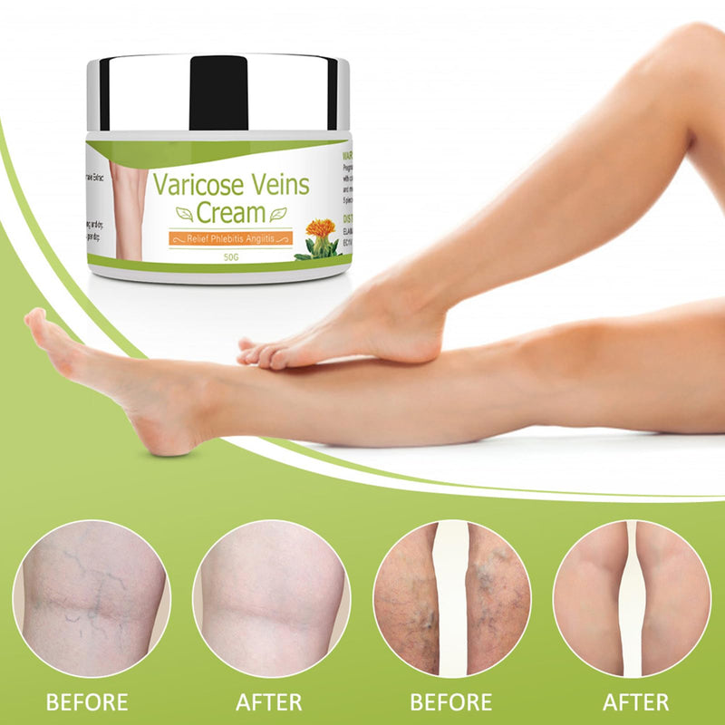 [Australia] - Varicose Veins Cream, Varicose Veins Cream, Cream for Spider Veins, Varicose Veins and Spider Veins Removal, Varicose Veins, Legs Care Ointment, Improve Blood Circulation for Legs, Legs Care Cream 