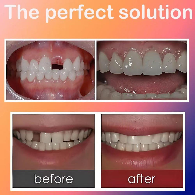 [Australia] - Generic ""Teeth Beauty Solution | Convenient and Portable | for Upper Teeth, Repairing Broken Teeth, Bright Smiles | Teeth Reshaping & Temporary Fix"", White 