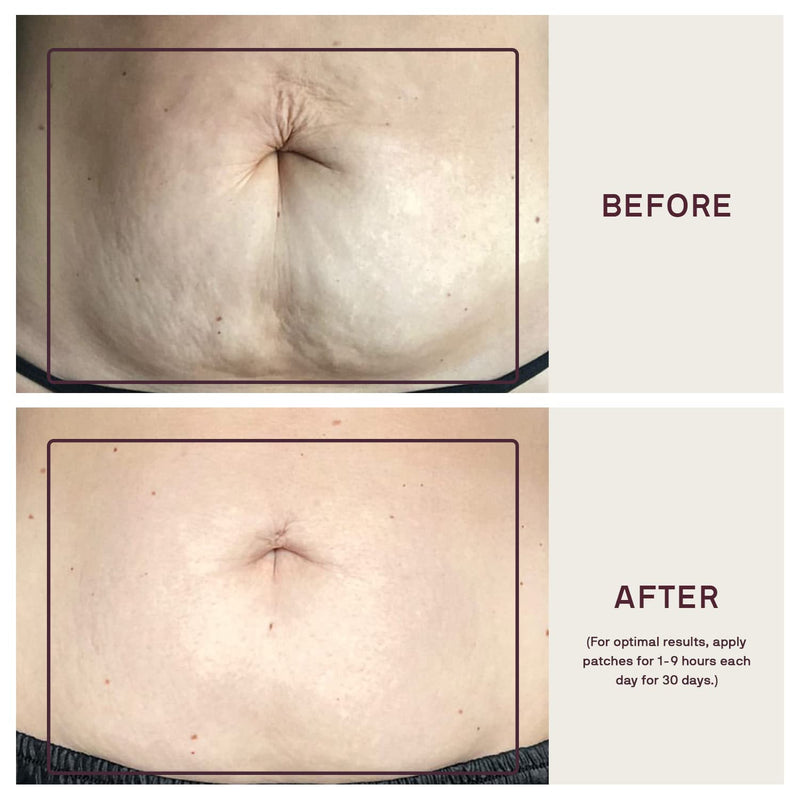 [Australia] - Dermaclara Silicone Body Patch to Prevent and Treat Stretch Marks - Pregnancy Safe Skin Care Silicone Patches for Scars - Stretch Mark Prevention Pregnancy Must Haves - 5" x 5" x .07" 