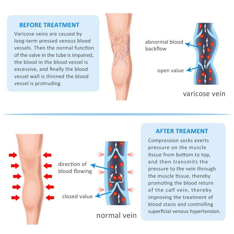[Australia] - 20-30mmHg Compression Pantyhose for Women, Medical Compression Stockings, High Waist Opaque Compression Tights for Lymphadema Edema, Swelling, Varicose Veins, Support Hose for Teacher Doctor XL Beige 
