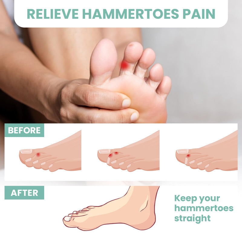 [Australia] - Welnove Hammertoe Corrector Gel Toe Straighteners - 8 Pcs Toe Support Pads Cushion - Realign Bent, Crooked, Curled, Claw, Hammer Toes - Soft Support 