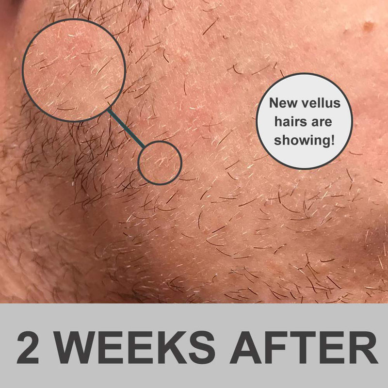 [Australia] - OCHILIMA Beard Growth Kit, 0.5mm Derma Roller/Beard Oil for Facial Hair Growth, for Men and Dads, Grooming Tool to Grow a Beard - Facilitates New and Old Hair Growth 2 Piece Set 