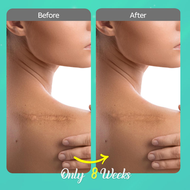 [Australia] - Scar Cream for Surgical Scars Removal: Advanced Silicone Scar Gel for Keloids, Acne, Stretch Marks, Pregnancy, C-Section & Burn Recovery ‚Äì Old & New Scar Treatment, 1 oz 1 Ounce (Pack of 1) 